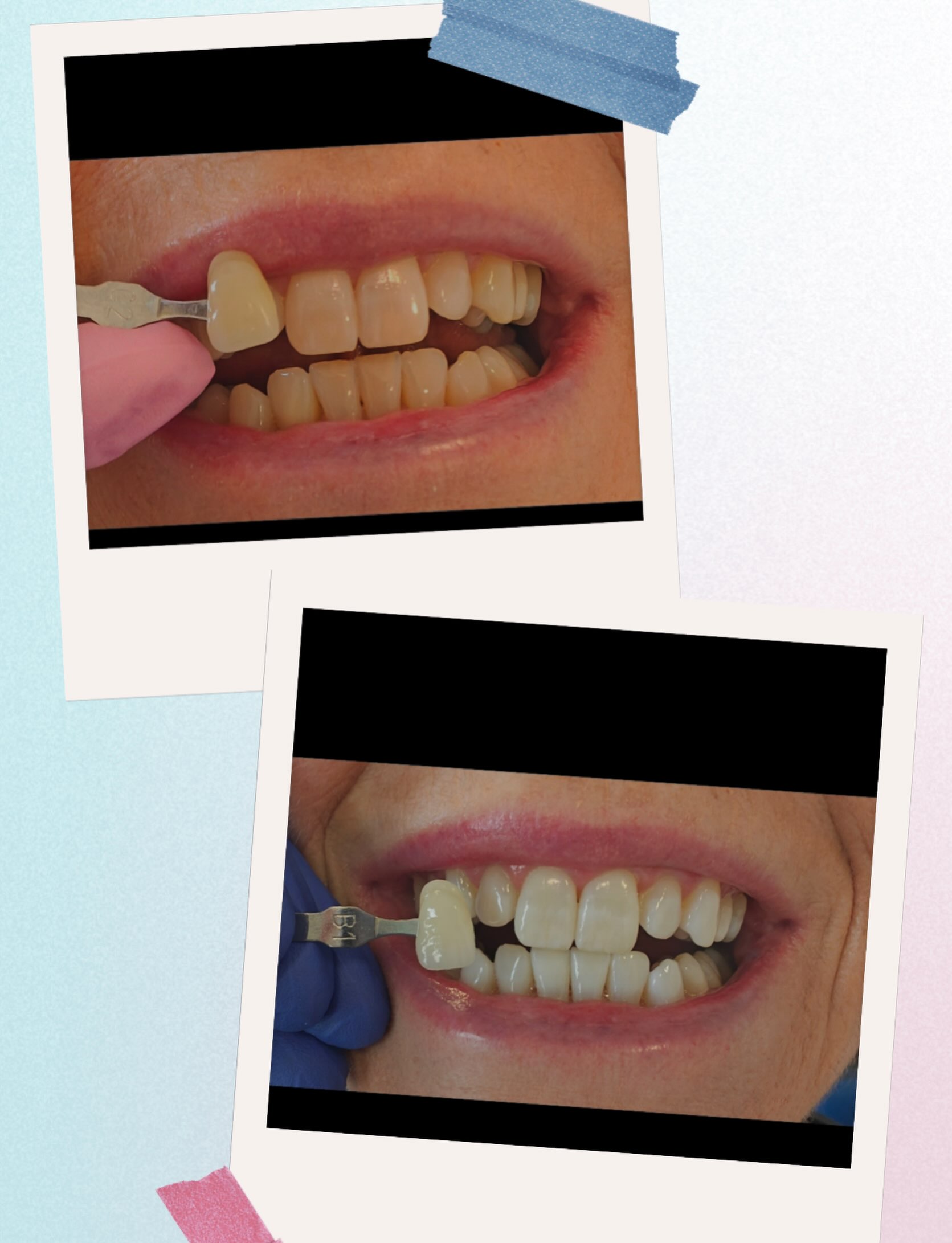 Look at these amazing results with James. A brighter, fresher smile from the comfort of your own home, using custom made whitening trays and professional whitening gel.

Noticeably brighter teeth
Easy and convenient to use at home
Beautiful, natural looking results

Ready to brighten your smile? Contact our friendly team to book your teeth whitening consultation!